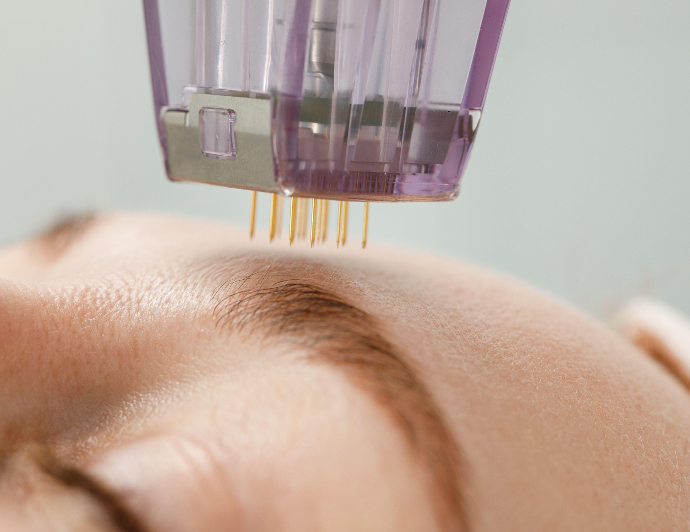 What is Microneedling?
